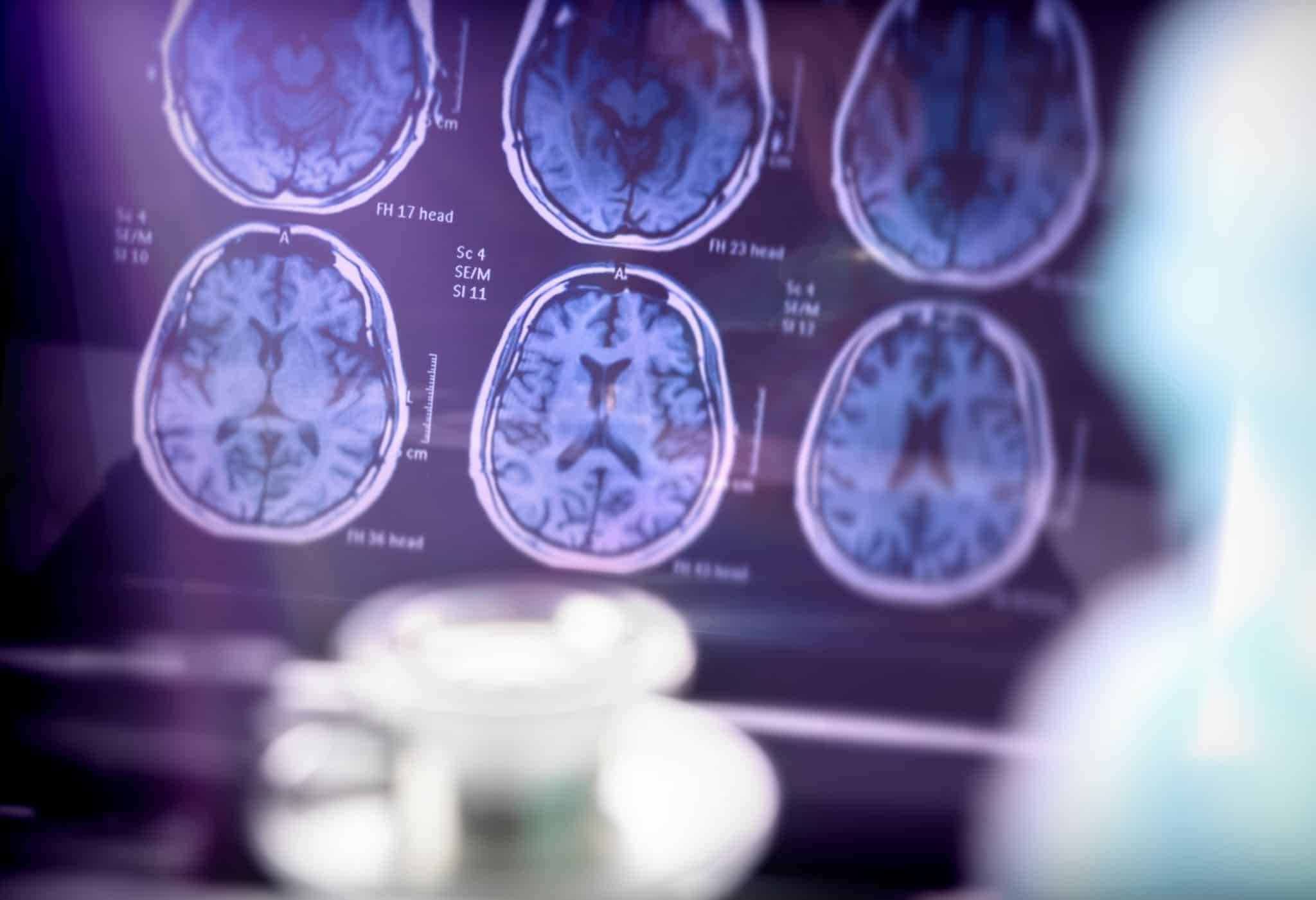 Ground-Breaking Therapies in the Fight Against Alzheimer’s