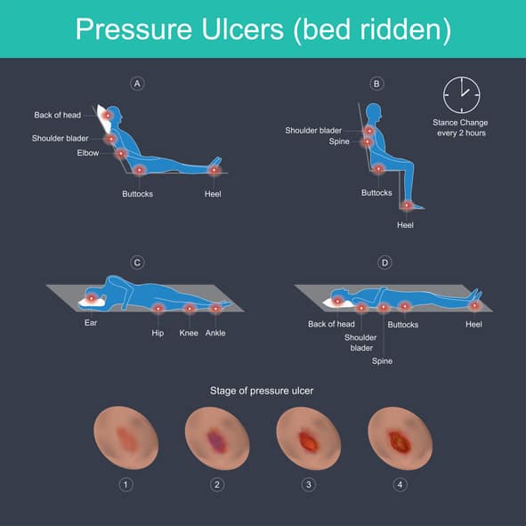 Detecting and preventing bedsores for seniors