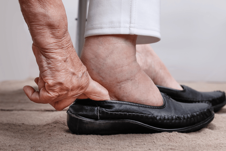 How Seniors Can Get Rid of Swollen Ankles